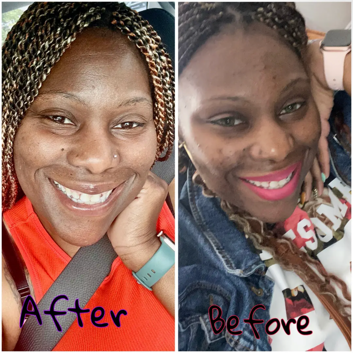Hyperpigmentation Bundle